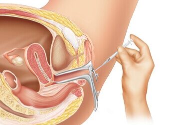 Guide to Intrauterine Insemination (IUI) by Experts at Aakash Fertility Centre & Hospital