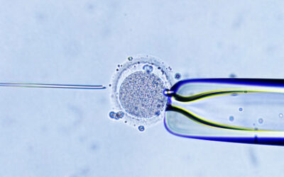 Enhancing Fertilization Precision with Intracytoplasmic Sperm Injection (ICSI)
